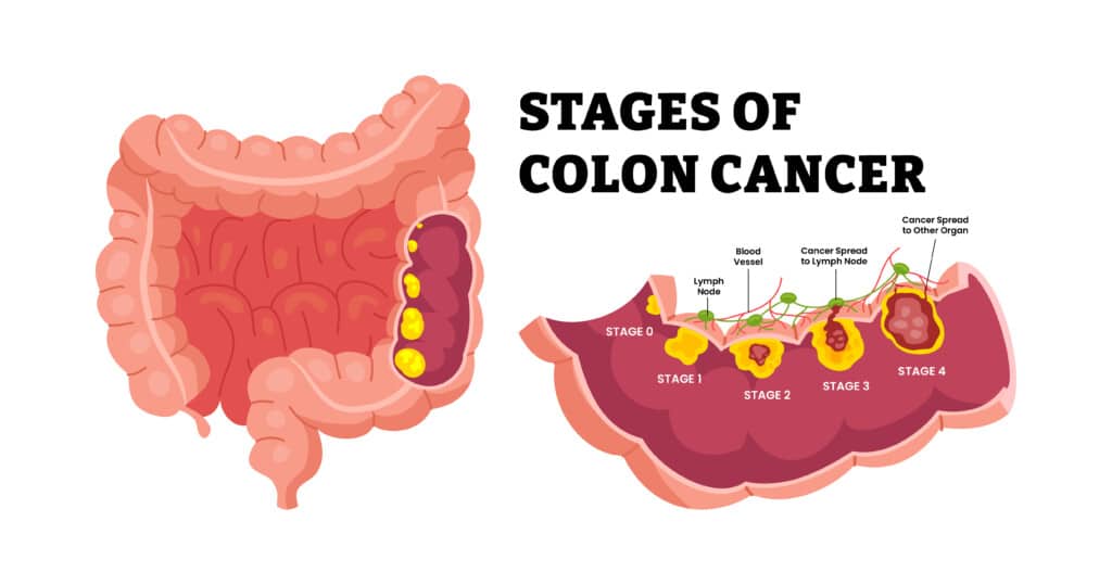 Illustration of a colon with polyps at stage 0, 1, 2, 3 and 4. Cross section showing stage 3 polyp spreading to lymph node and stage 4 polyp spreading to other organs. Colon cancer treatment in NYC.