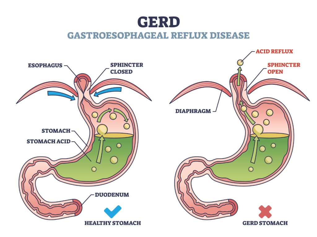 Graphic of a healthy stomach and esophagus and one with GERD. The one with GERD has an open lower esophageal sphincter allowing stomach acid to flow back up into the esophagus