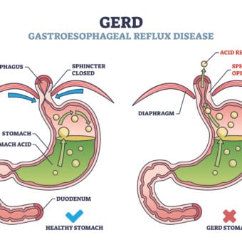 GERD vs. Acid Reflux: What’s the Difference?